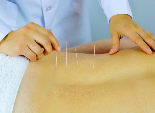 Acupuncture Treatments in Canterbury