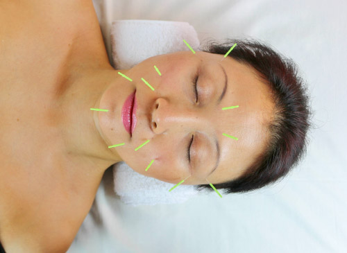 Cosmetic Acupuncture Treatments in Canterbury